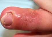 Herpes Kulit: Penularan dan Penyebarannya