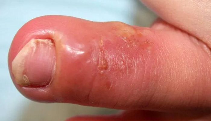 Herpes Kulit: Penularan dan Penyebarannya