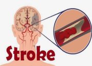 Waspada Stroke: Kenali Gejala & Cegah Sebelum Terlambat!
