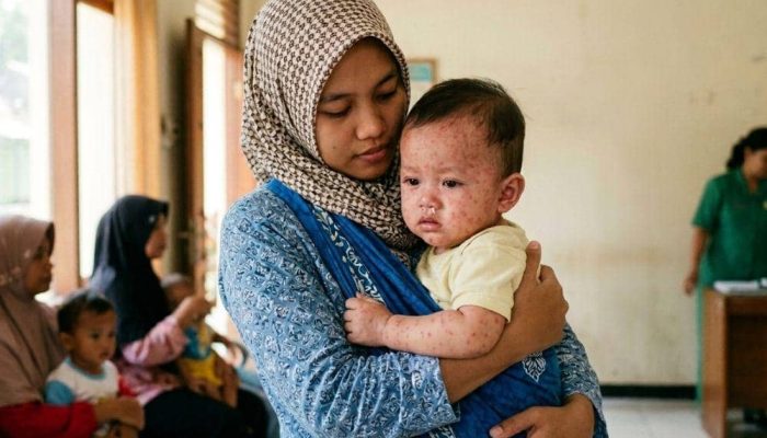6 Kondisi Anak Berisiko Parah Terkena Campak